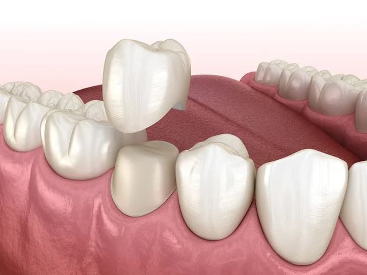 Crowns & Bridges — clinical illustration