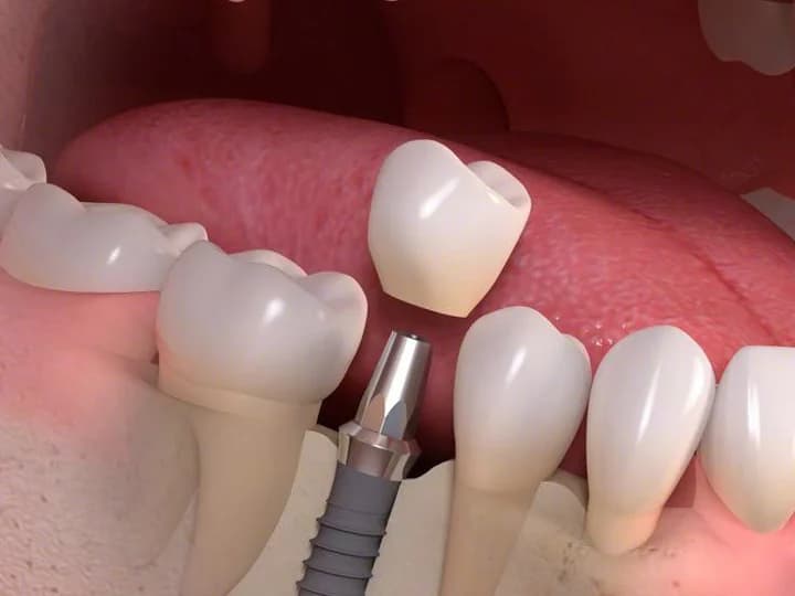 Implants — clinical illustration
