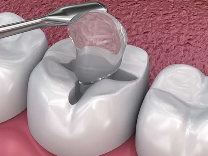 Fillings & Restoration — clinical illustration