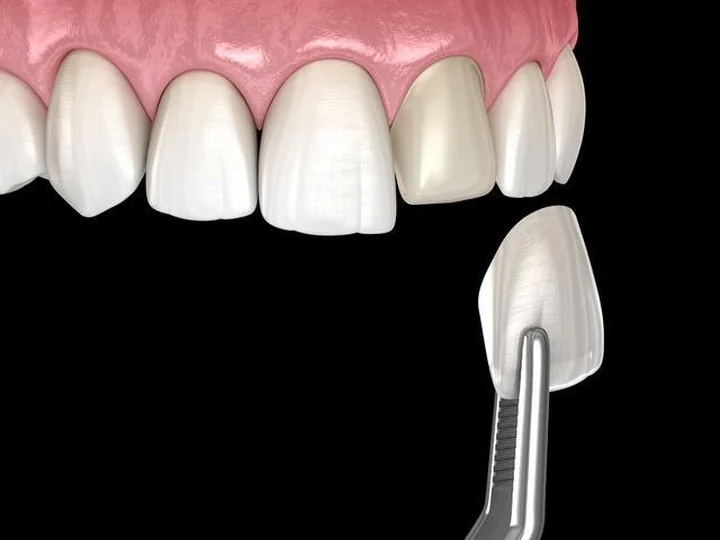 Porcelain Veneers — clinical illustration