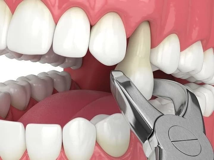 Tooth Extraction — clinical illustration